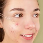 Close-up d'une jeune femme appliquant un sérum sur son visage pour un traitement contre l'acné et une routine de soins de la peau.