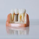 Modèle d'implant dentaire détaillé mettant en valeur la structure des dents à des fins éducatives.
