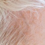 Gros plan sur le front d'une personne non identifiable avec les cheveux courts, clairs et équitables et des taches pigmentées.