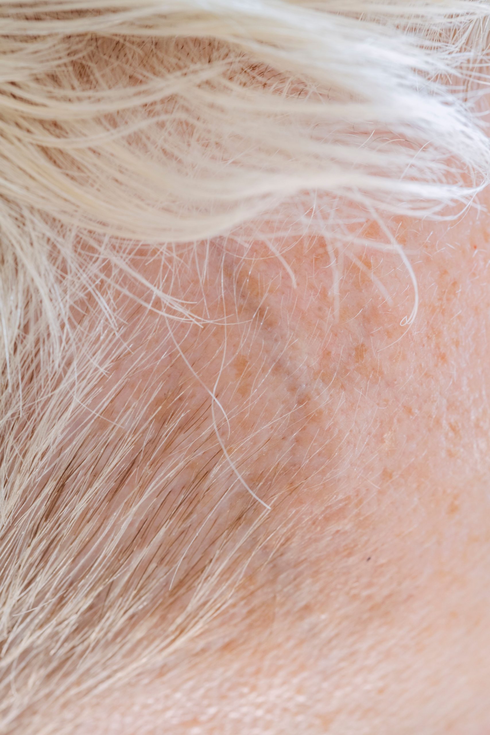 Gros plan sur le front d'une personne non identifiable avec les cheveux courts, clairs et équitables et des taches pigmentées.
