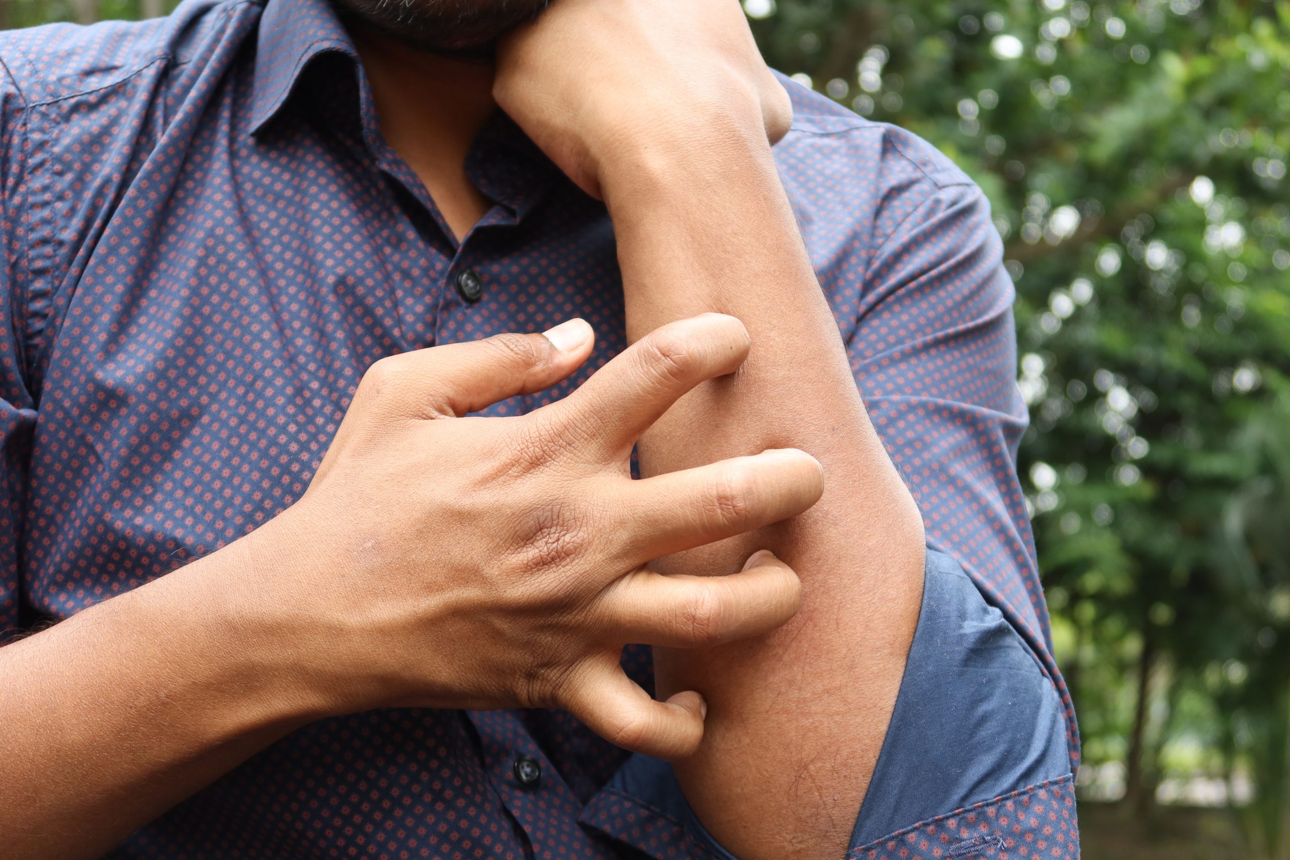 A man in a blue shirt scratching his arm outdoors, highlighting skin irritation. Un homme en chemise bleue se grattant le bras à l'extérieur, mettant en évidence une irritation de la peau.