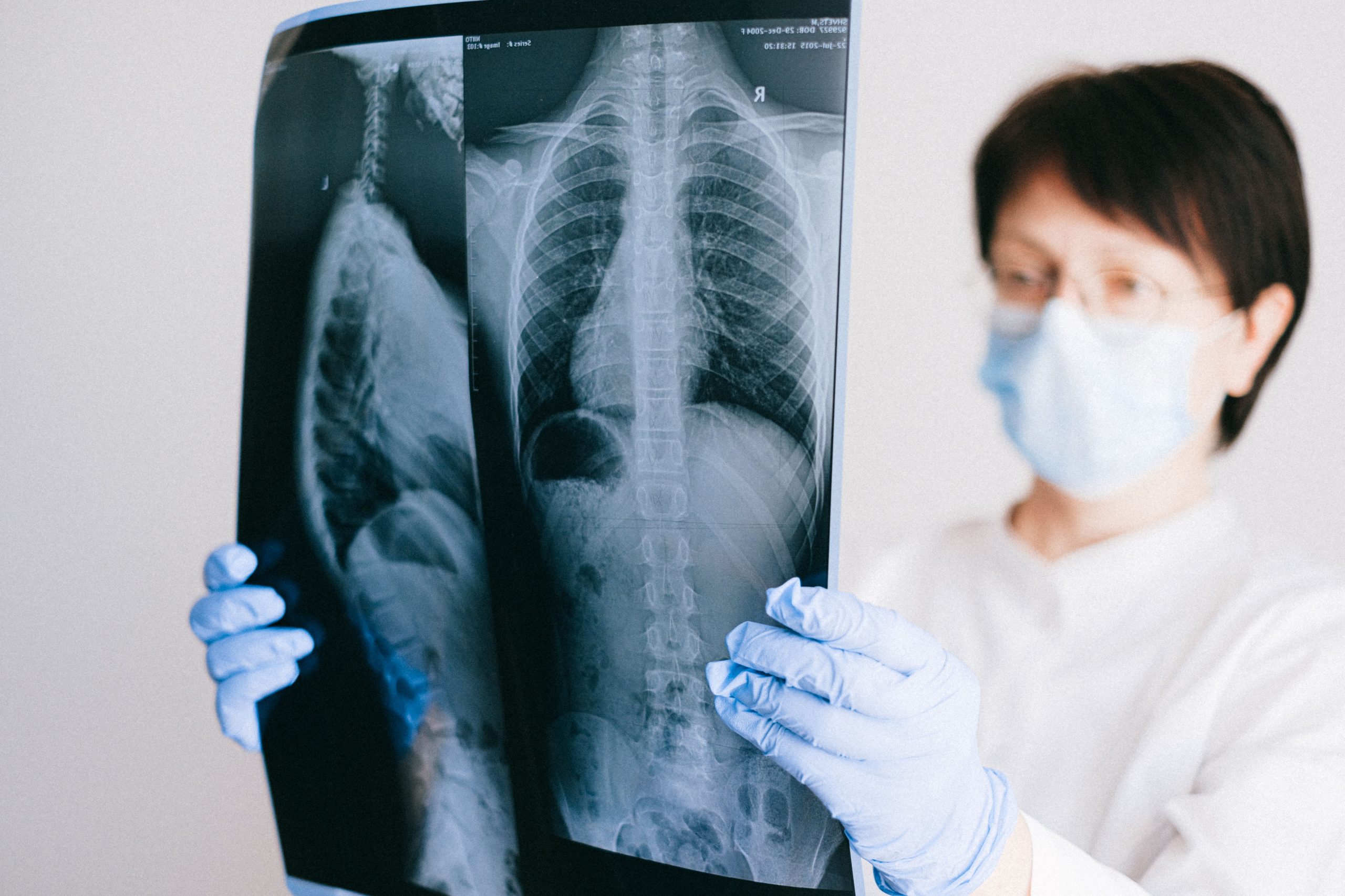 A medical professional analyzes a chest x-ray wearing gloves and a mask in a clinical setting. Un professionnel médical analyse une radiographie thoracique en portant des gants et un masque dans un environnement clinique.