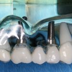 L'implant dentaire a plus de 60 ans