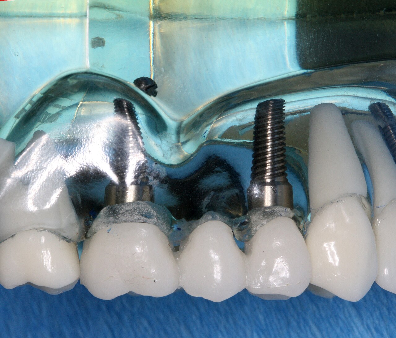 L'implant dentaire a plus de 60 ans